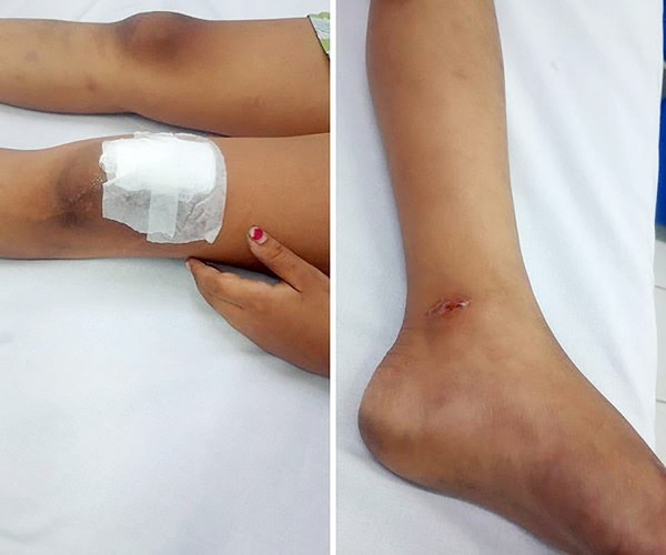 Menina é atropelada e motorista foge sem prestar socorro em Hortolândia