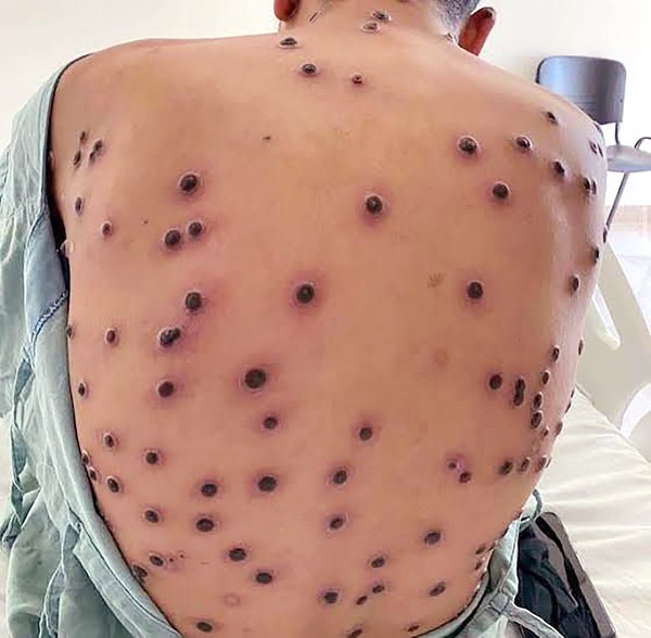 Hortolândia, Paulínia e Americana registram casos de mpox neste ano